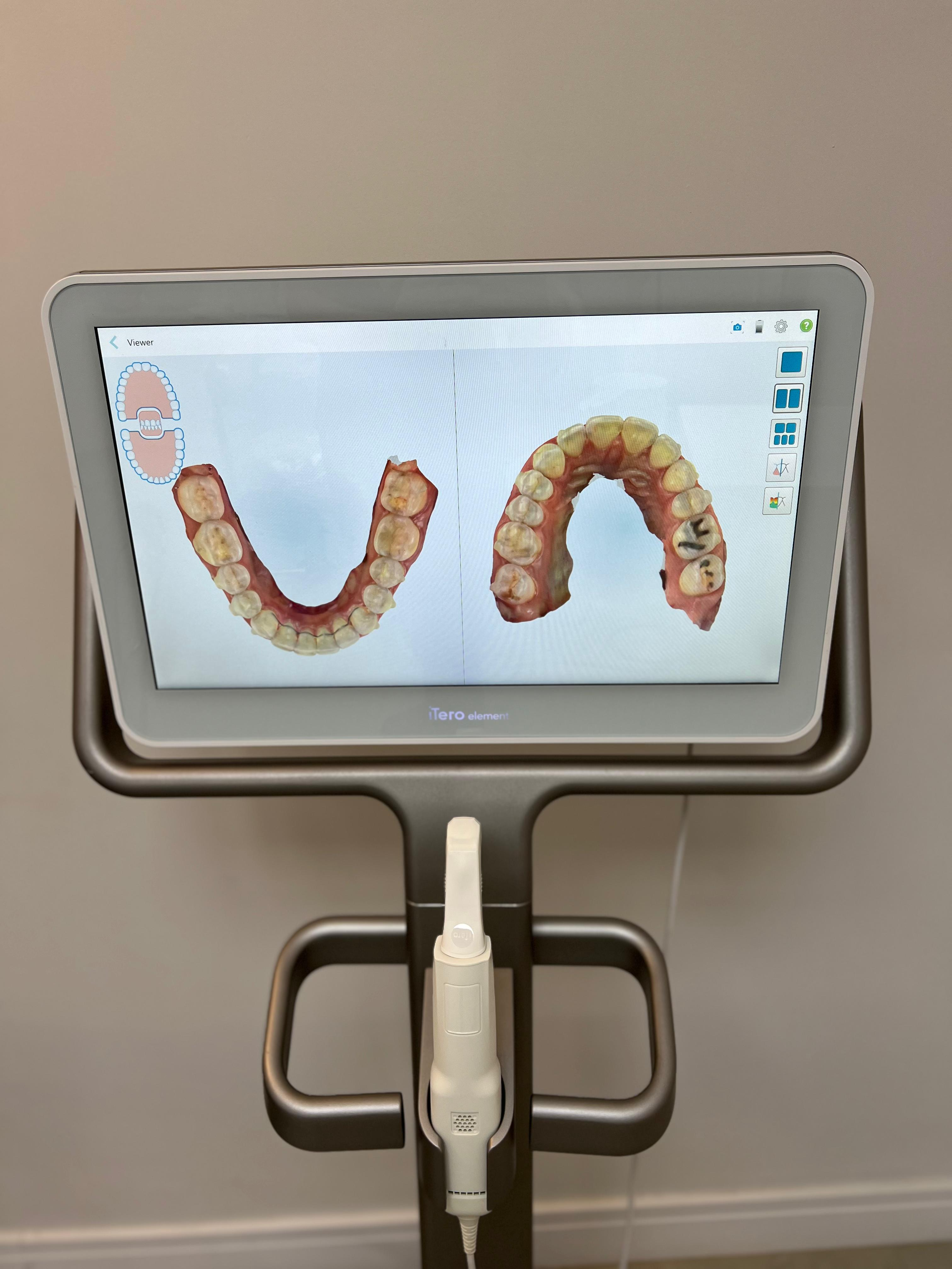 Scaner Intraoral Itero - dentista